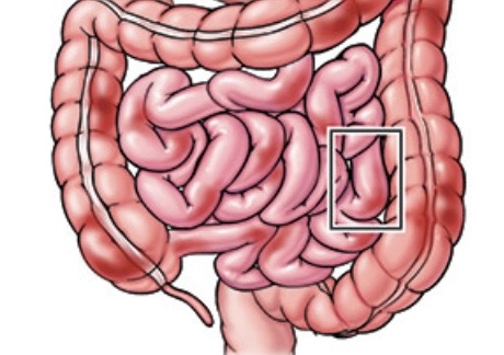 IBD